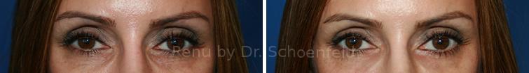 patient-7360-dermal-filler-before-after-11