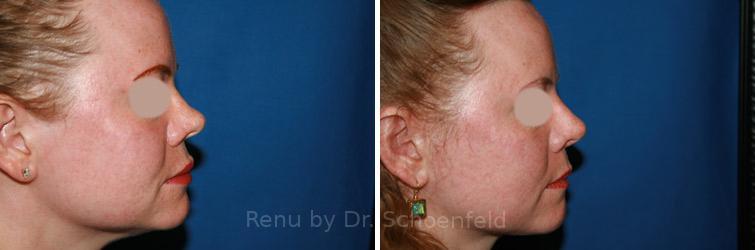 patient-7486-revision-rhinoplasty-before-after-23