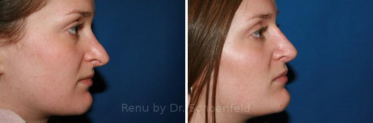 patient-7486-revision-rhinoplasty-before-after-29