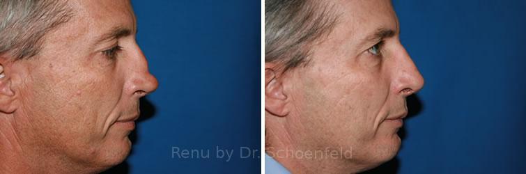 patient-7486-revision-rhinoplasty-before-after-33
