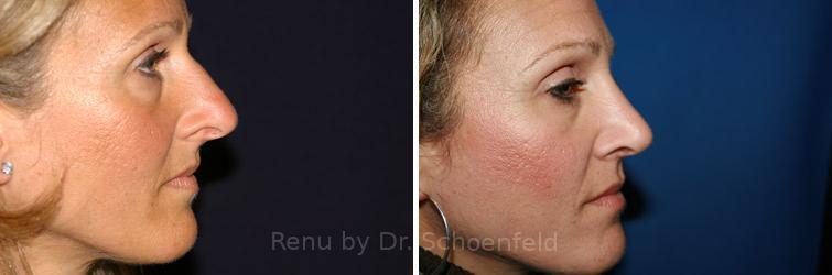 patient-7486-revision-rhinoplasty-before-after-39