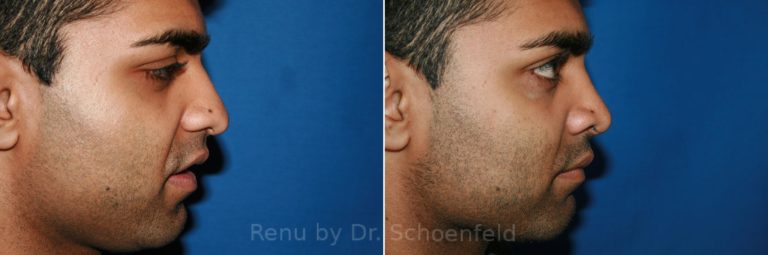 patient-9888-rhinoplasty-before-after-15-768x255