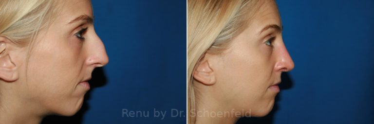 patient-9888-rhinoplasty-before-after-6-768x255