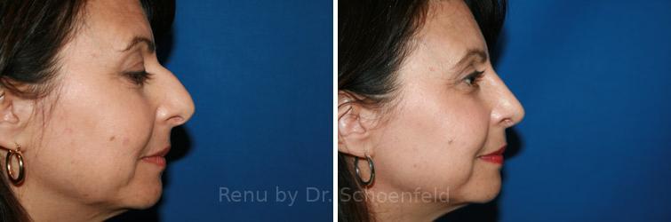 patient-9888-rhinoplasty-before-after-9 (1)