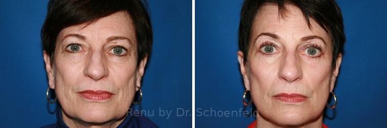 patient-9902-facelift-before-after-7
