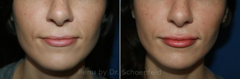 patient-9967-dermal-filler-before-after-17-768x255