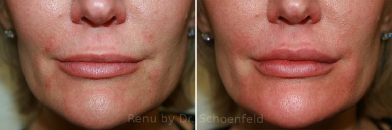 patient-9967-dermal-filler-before-after-18-768x255