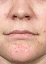 acne-treatment-washington-frontal-before-1