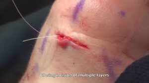 Chin Implant external approach | Philip S. Schoenfeld, M.D.