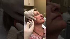 Botox in Chevy Chase, MD – Part 2