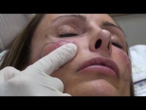 Dermal Fillers in Chevy Chase, MD