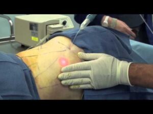 Laser Liposuction Philip Schoenfeld MD, FACS