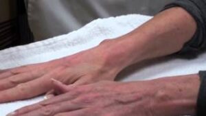 Hand Rejuvenation Philip Schoenfeld MD, FACS