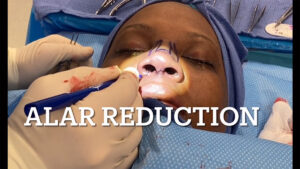 Alar Reduction