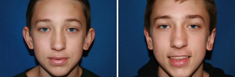 patient-8821-otoplasty-before-after-3