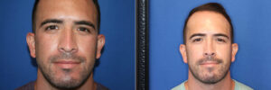 Rhinoplasty Patient 14805