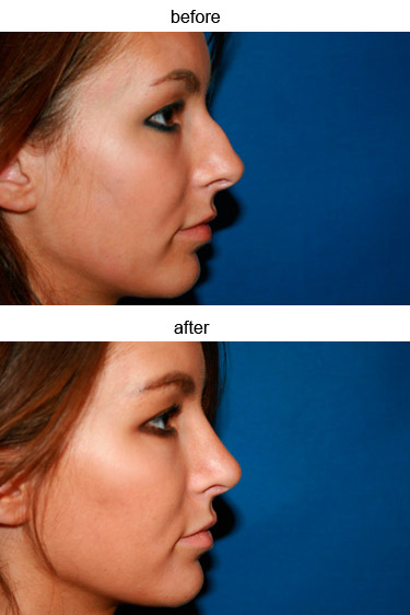 Rhinoplasty Photos