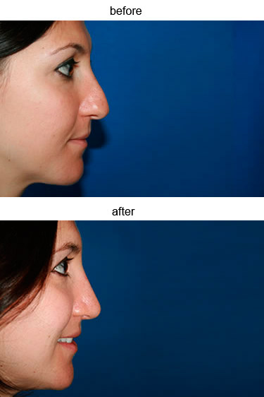 Rhinoplasty Photos