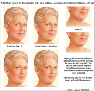 facelift Surgery MD